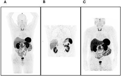 Non-functional alpha-cell hyperplasia with glucagon-producing NET: a case report